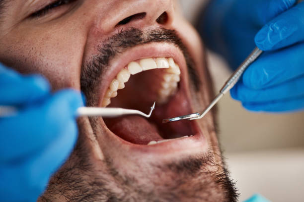 Best Knocked-Out Tooth (Avulsed Tooth) Treatment in Tara Hills, CA